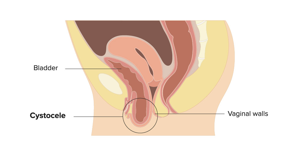 Illustrated medical cutaway diagram of a Cystocele. Arrows point to the Bladder, Cystocele and Vaginal Walls.